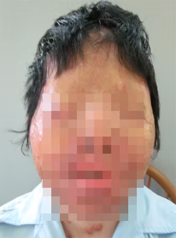 Chị Thúy trước khi phẫu thuật với khuôn mặt bị phá hủy toàn bộ. Ảnh: Bệnh viện. Chị Thúy trước khi phẫu thuật với khuôn mặt bị phá hủy toàn bộ. Ảnh: Bệnh viện.
