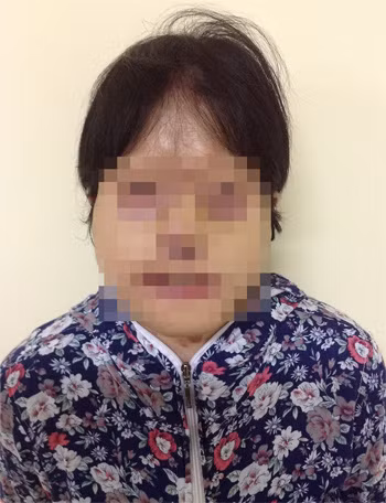 Sau 9 tiếng, chị Thúy đã được tái tạo một khuôn mặt mới từ da lưng. Bác sĩ hứa hẹn sẽ giúp chị lấy lại 80% khuôn mặt cũ. Ảnh: Bệnh viện. Sau 9 tiếng, chị Thúy đã được tái tạo một khuôn mặt mới từ da lưng. Bác sĩ hứa hẹn sẽ giúp chị lấy lại 80% khuôn mặt cũ. Ảnh: Bệnh viện.