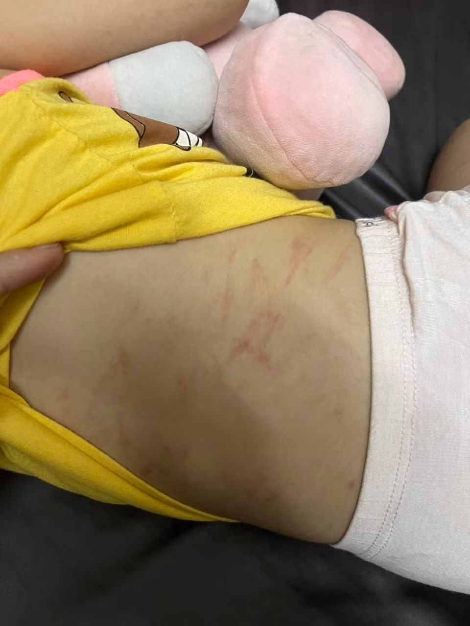 Vết đỏ sau lưng bé T. được gia đình chụp lại (Ảnh: Phụ huynh cung cấp)