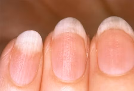 5. Móng tay gợn sóng: Nếu bề mặt móng tay xuất hiện vệt gợn sóng hoặc hõm xuống, đó là dấu hiệu ban đầu của bệnh vẩy nến hoặc viêm khớp vảy nến. Thông thường, khi bị bệnh, móng sẽ đổi màu và da dưới móng chuyển sang màu nâu đỏ. Xem thêm: Cảm cúm, cảm lạnh dùng thực phẩm gì có lợi nhất?