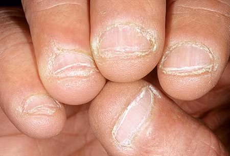 9. Móng tay bị gặm: Gặm móng tay chỉ là một thói quen, nhưng trong một vài trường hợp đó lại là dấu hiệu của bệnh lo lắng kéo dài (do quá trình điều trị gây ra). Cắn hay cạy móng tay còn liên quan tới chứng rối loạn ám ảnh cưỡng chế. Đây là một rối loạn tâm lý có tính chất mãn tính, người bệnh thường có những ý nghĩ ám ảnh, lo lắng không có lý do chính đáng và phải thực hiện các hành vi có tính chất ép buộc để giảm bớt căng thẳng. Nếu không thể ngừng thói quen gặm hay cạy móng, bạn nên nói chuyện với bác sĩ. Xem thêm: Cảm cúm, cảm lạnh dùng thực phẩm gì có lợi nhất?