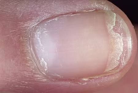 6. Móng tay bị rạn, nứt tách: Móng tay khô, dễ gãy, thường xuyên bị nứt tách có thể là triệu chứng của bệnh về tuyến giáp. Nếu móng tay bạn bị nứt tách, kèm theo đó có màu vàng thì rất có khả năng móng tay bị nhiễm nấm. Xem thêm: Cảm cúm, cảm lạnh dùng thực phẩm gì có lợi nhất?