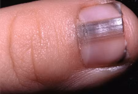 8. Đường viền màu tối bên dưới móng: Ngay khi dưới móng tay xuất hiện những đường viền màu tối, bạn nên điều tra căn nguyên càng sớm càng tốt. Đôi khi những viền màu tối này là triệu chứng của khối u hắc tố ác tính - dạng ung thư da nguy hiểm nhất. Xem thêm: Cảm cúm, cảm lạnh dùng thực phẩm gì có lợi nhất?