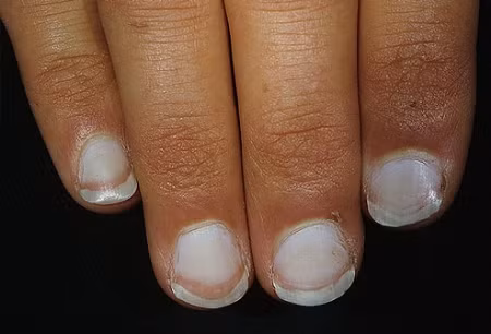 2. Móng tay trắng: Nếu móng tay bạn hầu hết có màu trắng và viền sẫm màu, có thể bạn đã gặp những vấn đề về gan như viêm gan. Ngoài ra, các ngón tay có màu vàng cũng là dấu hiệu của bệnh về gan. Xem thêm: Cảm cúm, cảm lạnh dùng thực phẩm gì có lợi nhất?