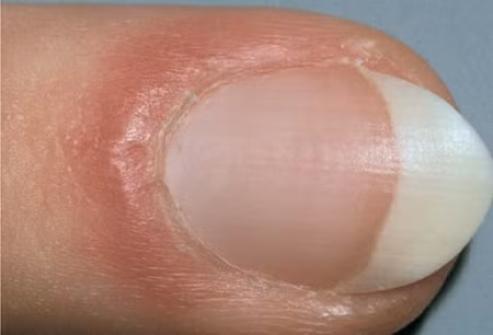 7. Sưng phồng da bao quanh móng: Nếu da xung quanh móng xuất hiện màu đỏ và sưng phồng, đó có thể là dấu hiệu của viêm lớp da bao phía trong gốc móng. Hiện tượng này xuất hiện do bệnh Lupus hoặc chứng rối loạn các mô liên kết. Ngoài ra, việc bị nhiễm trùng có thể khiến lớp da quanh móng sưng đỏ. Xem thêm: Cảm cúm, cảm lạnh dùng thực phẩm gì có lợi nhất?
