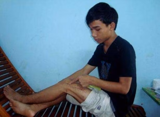 Vết thương ở chân em Hiếu ngày càng đau nhức, khiến việc sinh hoạt vô cùng khó khăn
