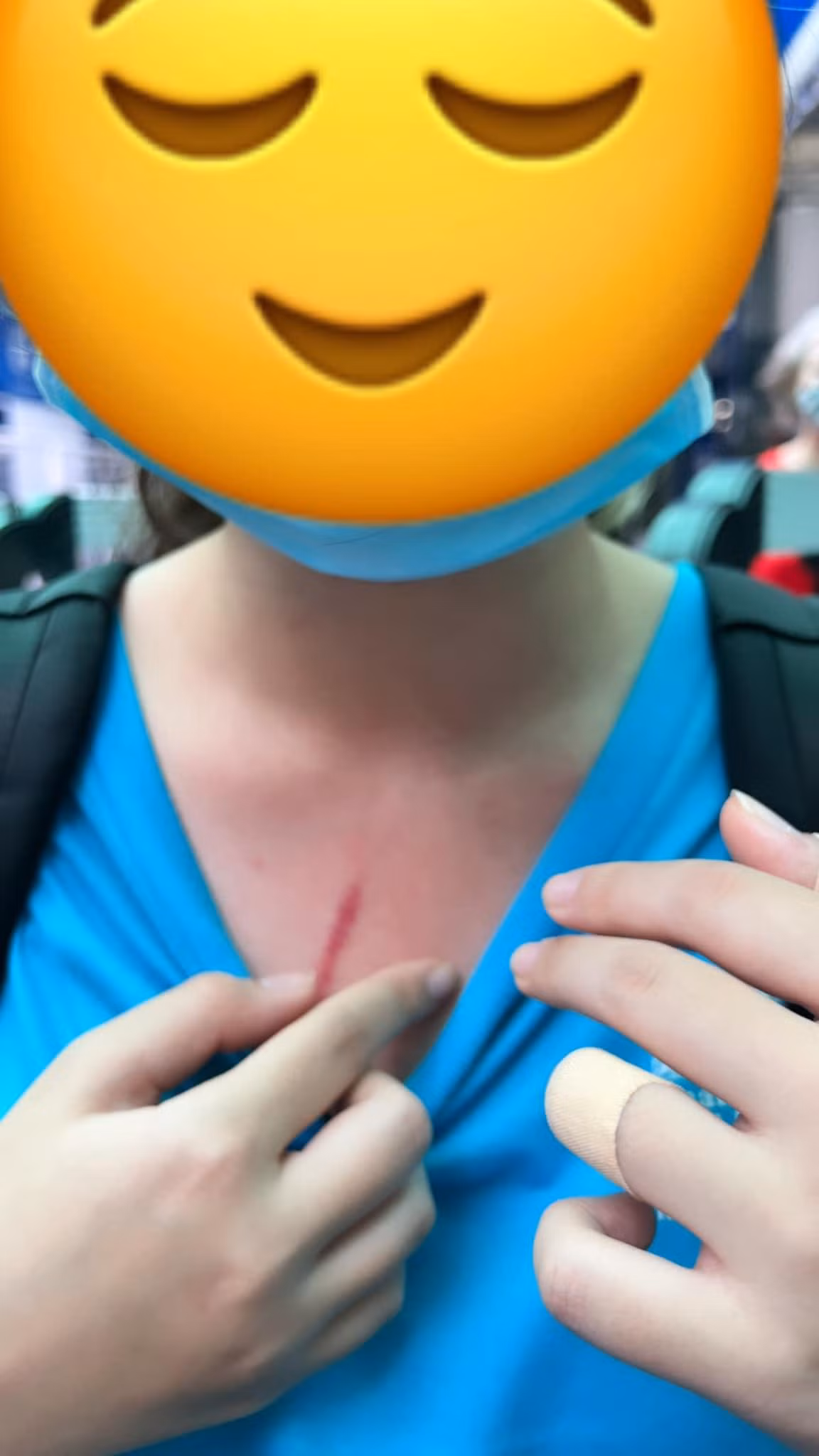 Vết xước trên cổ được cho là trên người con của chị T. (Ảnh: FB T.H.T)