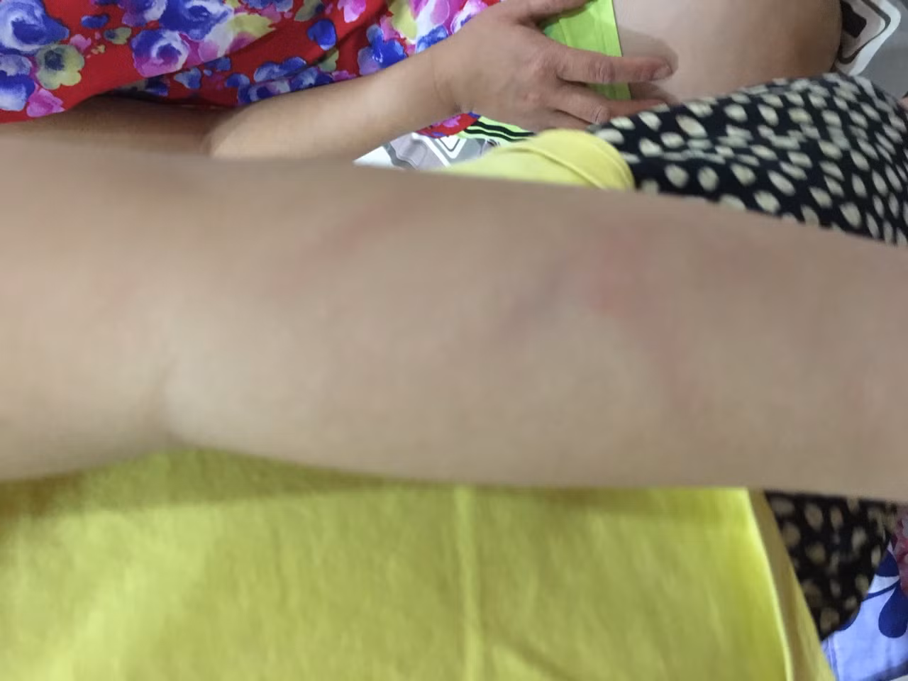 Vết trầy xước trên tay của học sinh do bị cô giáo bạo hành. (Ảnh: Gia đình nạn nhân cung cấp) Vết trầy xước trên tay của học sinh do bị cô giáo bạo hành. (Ảnh: Gia đình nạn nhân cung cấp)