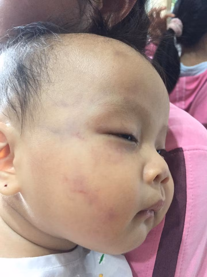 Vùng má phải, trán và mắt của bé Châu Nhã Uyên (8 tháng tuổi) bị bầm, sưng tím. Ảnh: Phan Tuyết Vùng má phải, trán và mắt của bé Châu Nhã Uyên (8 tháng tuổi) bị bầm, sưng tím. Ảnh: Phan Tuyết