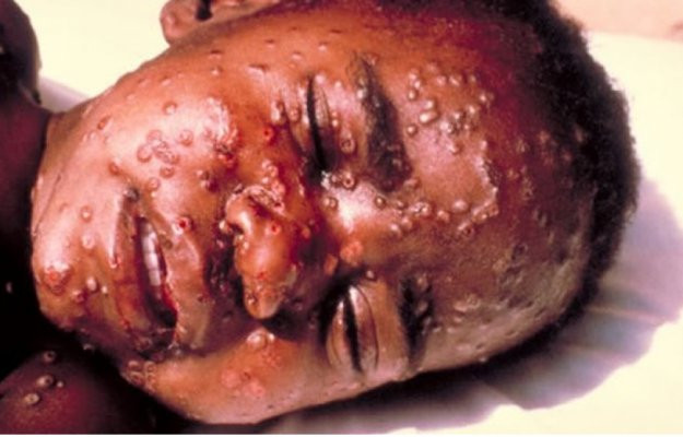 WHO cảnh báo nguy cơ Ebola bùng phát và lây lan nhanh ở Đông Nam Á là rất lớn. Ảnh minh họa, nguồn internet.