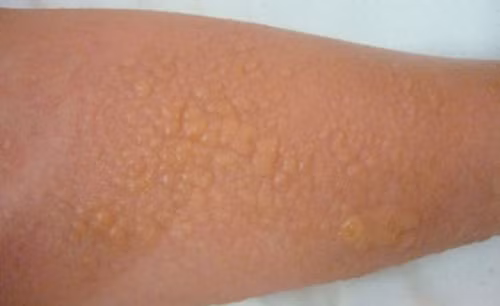 Cánh tay bị phổng rộp sau khi lột da tắm trắng