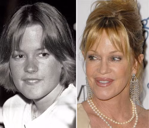 Năm 1976, Melanie Griffith thật ngọt ngào với đôi môi mỏng, khuôn mặt thơ ngây, nhưng bây giờ hình ảnh đó đã chìm vào dĩ vãng. Khuôn mặt ngày càng già nua, nhưng đôi môi của nữ diễn viên lại sưng lên một cách đáng sợ. Xem thêm: Sao xấu - Sao đẹp/ Thời trang sao