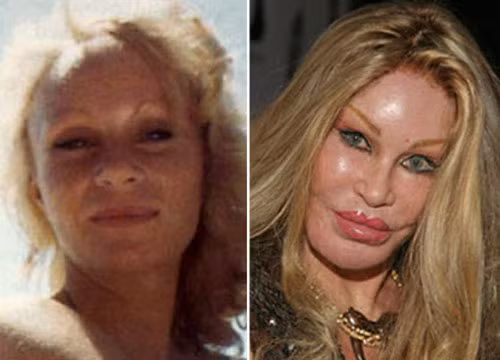 Jocelyn Wildenstein khi còn trẻ trông rất tự nhiên, nhưng khuôn mặt cô bị biến dạng hẳn kể từ khi "nghiện" dao kéo.. Xem thêm: Sao xấu - Sao đẹp/ Thời trang sao