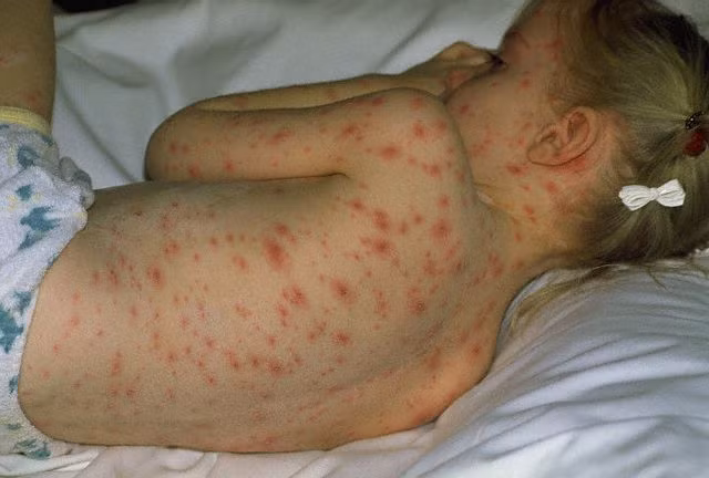 Bệnh thủy đậu: Thủy đậu là bệnh do virus gây ra. Trẻ bị thủy đậu trước tiên sẽ có triệu chứng ngây ngấy sốt, sau có thể sốt cao. Bệnh có thể kéo dài 4-5 ngày.(Ảnh: ITN) Xem thêm: Chùm ảnh: Sự nguy hiểm của việc sâu răng ở trẻ Bệnh thủy đậu: Thủy đậu là bệnh do virus gây ra. Trẻ bị thủy đậu trước tiên sẽ có triệu chứng ngây ngấy sốt, sau có thể sốt cao. Bệnh có thể kéo dài 4-5 ngày.(Ảnh: ITN) Xem thêm: Chùm ảnh: Sự nguy hiểm của việc sâu răng ở trẻ