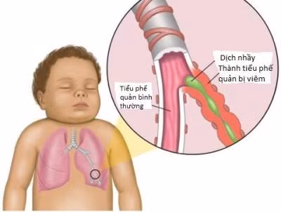 Trẻ bị viêm phế quản cấp vẫn phải bú mẹ, nếu trẻ không tự bú được thì phải vắt sữa ra bình, cốc hoặc cho trẻ ăn sữa ngoài nếu mẹ không có sữa. Để bảo đảm chế độ dinh dưỡng, các bà mẹ vẫn duy trì chế độ ăn có nhiều vitamin, muối khoáng, ăn nhiều hoa quả, ăn tăng cường nếu trẻ trong thời kỳ ăn dặm, cho trẻ nằm nơi thoáng mát...(Ảnh: ITN) Xem thêm: Chùm ảnh: Sự nguy hiểm của việc sâu răng ở trẻ Trẻ bị viêm phế quản cấp vẫn phải bú mẹ, nếu trẻ không tự bú được thì phải vắt sữa ra bình, cốc hoặc cho trẻ ăn sữa ngoài nếu mẹ không có sữa. Để bảo đảm chế độ dinh dưỡng, các bà mẹ vẫn duy trì chế độ ăn có nhiều vitamin, muối khoáng, ăn nhiều hoa quả, ăn tăng cường nếu trẻ trong thời kỳ ăn dặm, cho trẻ nằm nơi thoáng mát...(Ảnh: ITN) Xem thêm: Chùm ảnh: Sự nguy hiểm của việc sâu răng ở trẻ