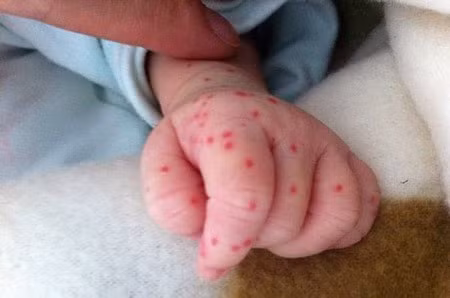 Mụn nhọt: Vào mùa hè nếu không giữ gìn vệ sinh da tốt, trẻ rất dễ bị mụn nhọt. Mụn nhọt ở mức độ nhẹ có thể tự khỏi và không ảnh hưởng tới cơ thể, không gây nguy hiểm, nếu bị nặng hơn, mụn nhọt có thể gây ra hiện tượng đau nhức, sốt, trẻ biếng ăn, hay bứt rứt, phải đưa trẻ đi khám bác sĩ khám, có thể chích mụn để thoát lưu mủ.(Ảnh: ITN) Xem thêm: Chùm ảnh: Sự nguy hiểm của việc sâu răng ở trẻ Mụn nhọt: Vào mùa hè nếu không giữ gìn vệ sinh da tốt, trẻ rất dễ bị mụn nhọt. Mụn nhọt ở mức độ nhẹ có thể tự khỏi và không ảnh hưởng tới cơ thể, không gây nguy hiểm, nếu bị nặng hơn, mụn nhọt có thể gây ra hiện tượng đau nhức, sốt, trẻ biếng ăn, hay bứt rứt, phải đưa trẻ đi khám bác sĩ khám, có thể chích mụn để thoát lưu mủ.(Ảnh: ITN) Xem thêm: Chùm ảnh: Sự nguy hiểm của việc sâu răng ở trẻ