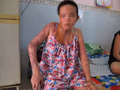 Kẻ tạt axit cả gia đình đi chữa bệnh tâm thần, An ninh Xã hội, tat axit, tam than, tat axit ca nha, mu hai mat, bao, bao cong an, bao an ninh