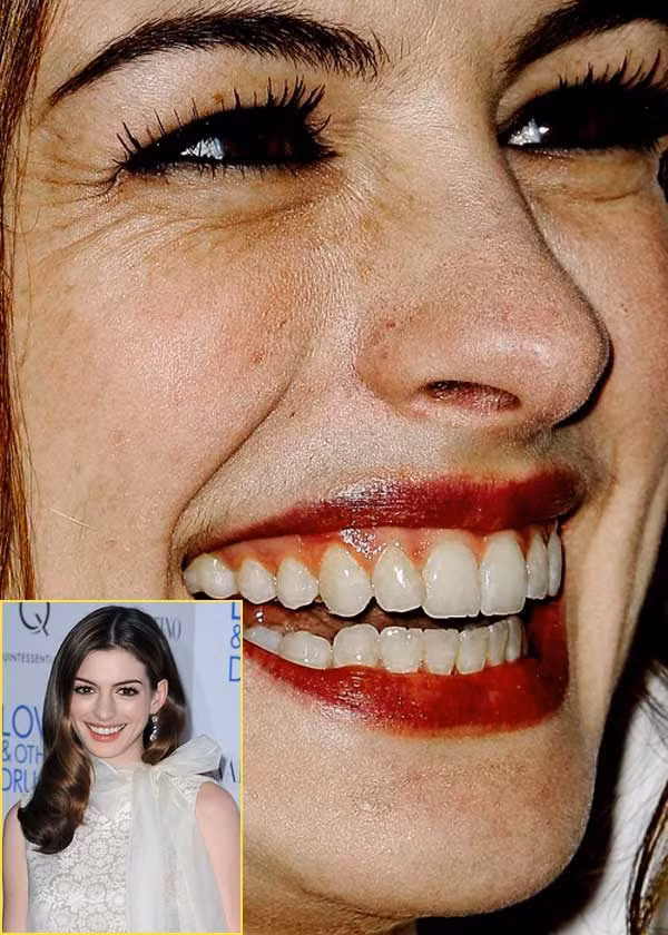 Trong khi đó, "công chúa" Anne Hathaway lại sớm lộ rõ sự già nua. Khóe mắt cô nàng hằn in nhiều dấu chân chim. (Ảnh: Xz) Xem thêm: Điểm danh những chiếc cằm mới của Sao Việt / Bộ sưu tập váy xinh chào hè 2012. Trong khi đó, "công chúa" Anne Hathaway lại sớm lộ rõ sự già nua. Khóe mắt cô nàng hằn in nhiều dấu chân chim. (Ảnh: Xz) Xem thêm: Điểm danh những chiếc cằm mới của Sao Việt / Bộ sưu tập váy xinh chào hè 2012.