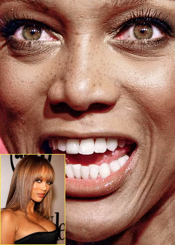 Siêu mẫu Tyra Banks cũng không phải cô gái hoàn hảo. Những đốm tàn nhang nơi sống mũi và hàm răng khấp khểnh là điểm trừ thấy rõ nhất. (Ảnh: Xz) Xem thêm: Điểm danh những chiếc cằm mới của Sao Việt / Bộ sưu tập váy xinh chào hè 2012. Siêu mẫu Tyra Banks cũng không phải cô gái hoàn hảo. Những đốm tàn nhang nơi sống mũi và hàm răng khấp khểnh là điểm trừ thấy rõ nhất. (Ảnh: Xz) Xem thêm: Điểm danh những chiếc cằm mới của Sao Việt / Bộ sưu tập váy xinh chào hè 2012.