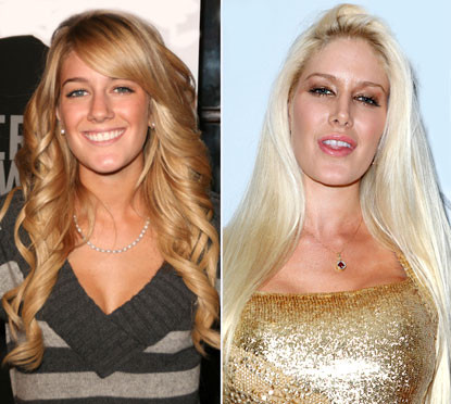 Heidi Montag có thể coi là thảm họa phẫu thuật thẩm mỹ trẻ nhất thế giới. Ngôi sao "The Hills" bắt đầu đụng tới dao kéo năm 2007 khi mới 21 tuổi. Cô từng gây sốc khi tiết lộ đã trải qua 10 cuộc phẫu thuật thẩm mỹ chỉ trong 1 ngày khiến cơ thể hoàn toàn biến đổi theo chiều hướng tồi tệ. Xem thêm: Điểm danh những chiếc cằm mới của Sao Việt