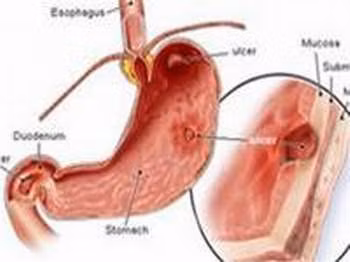 Ít vận động hàng ngày cũng làm cho lượng thức ăn tích lũy trong đường tiêu hóa do không tiêu hóa hết khiến nhu động ruột bị ảnh hưởng, lâu ngày có thể gây ra loét dạ dày, loét tá tràng...