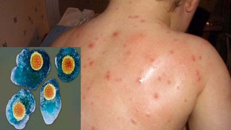 Virut Varicella zoster gây bệnh thủy đậu (ảnh nhỏ) và tổn thương do thủy đậu trên da (ảnh lớn) . Virut Varicella zoster gây bệnh thủy đậu (ảnh nhỏ) và tổn thương do thủy đậu trên da (ảnh lớn) .