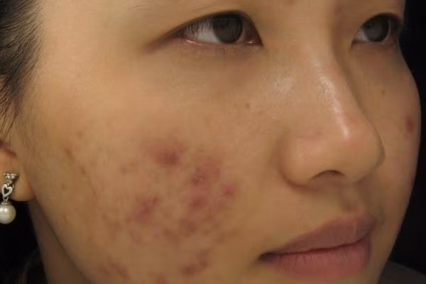 Mụn trứng cá để lại thâm sẹo gây mất thẩm mỹ và tự tin cho người bệnh Mụn trứng cá để lại thâm sẹo gây mất thẩm mỹ và tự tin cho người bệnh