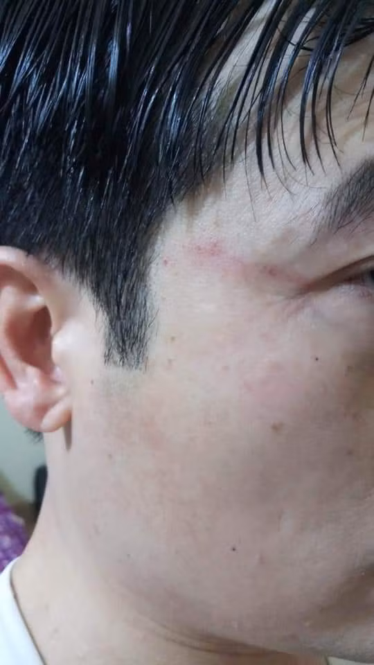 Ông Phạm Văn Tuyên bị hành hung sau khi rời trường Trung học cơ sở Tân Quang II (Ảnh: Phụ huynh cung cấp) Ông Phạm Văn Tuyên bị hành hung sau khi rời trường Trung học cơ sở Tân Quang II (Ảnh: Phụ huynh cung cấp)