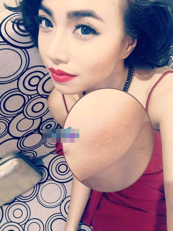 Khuôn mặt Đinh Ngọc Diệp lồi lõm do vết tích của mụn. Khuôn mặt Đinh Ngọc Diệp lồi lõm do vết tích của mụn.