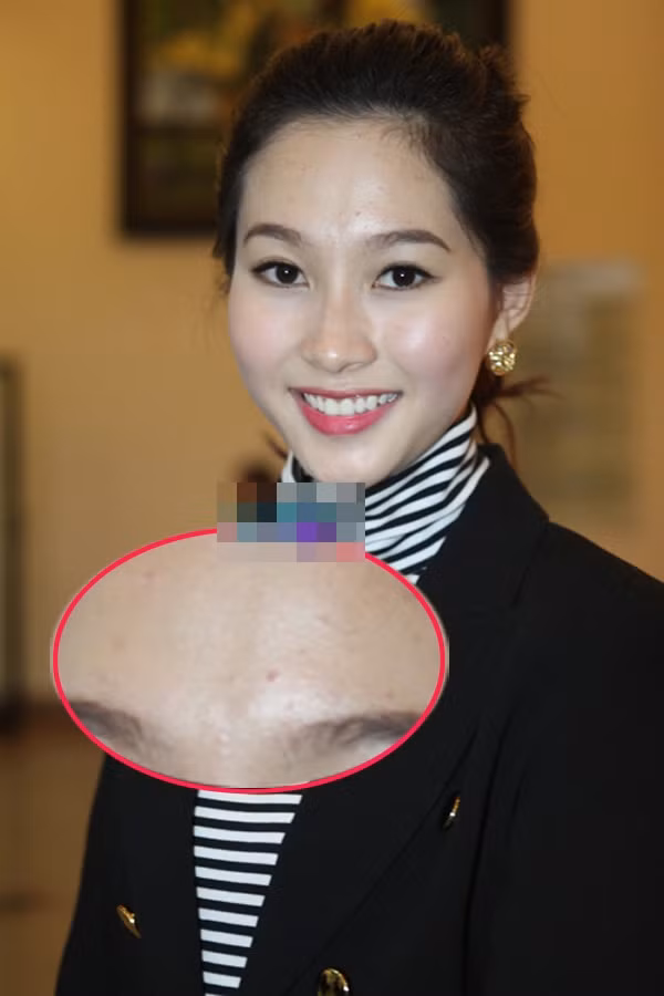 Khuôn mặt của Hoa hậu Thu Thảo trở nên xấu bởi có những đám mụn li ti, ửng đỏ. Khuôn mặt của Hoa hậu Thu Thảo trở nên xấu bởi có những đám mụn li ti, ửng đỏ.