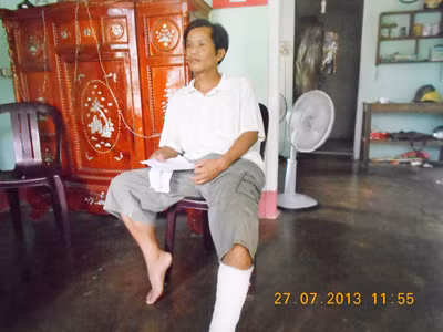 Anh Hoàng bị người nhà chồng của tình nhân đánh đến gãy chân, hiện chưa hồi phục. Anh Hoàng bị người nhà chồng của tình nhân đánh đến gãy chân, hiện chưa hồi phục.