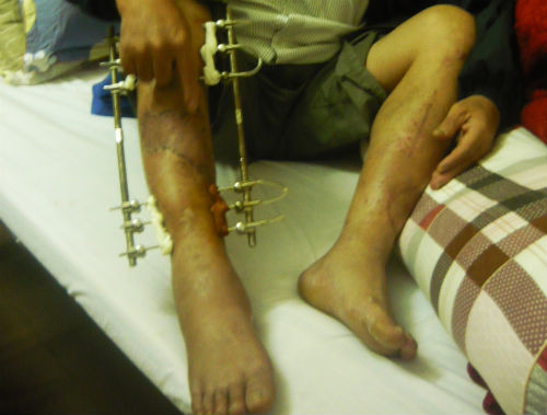 Cú tông như trời giáng của quái xế khiến Trung tá Cường bị gãy cả hai chân. Vết sẹo chi chít trên hai đôi chân.