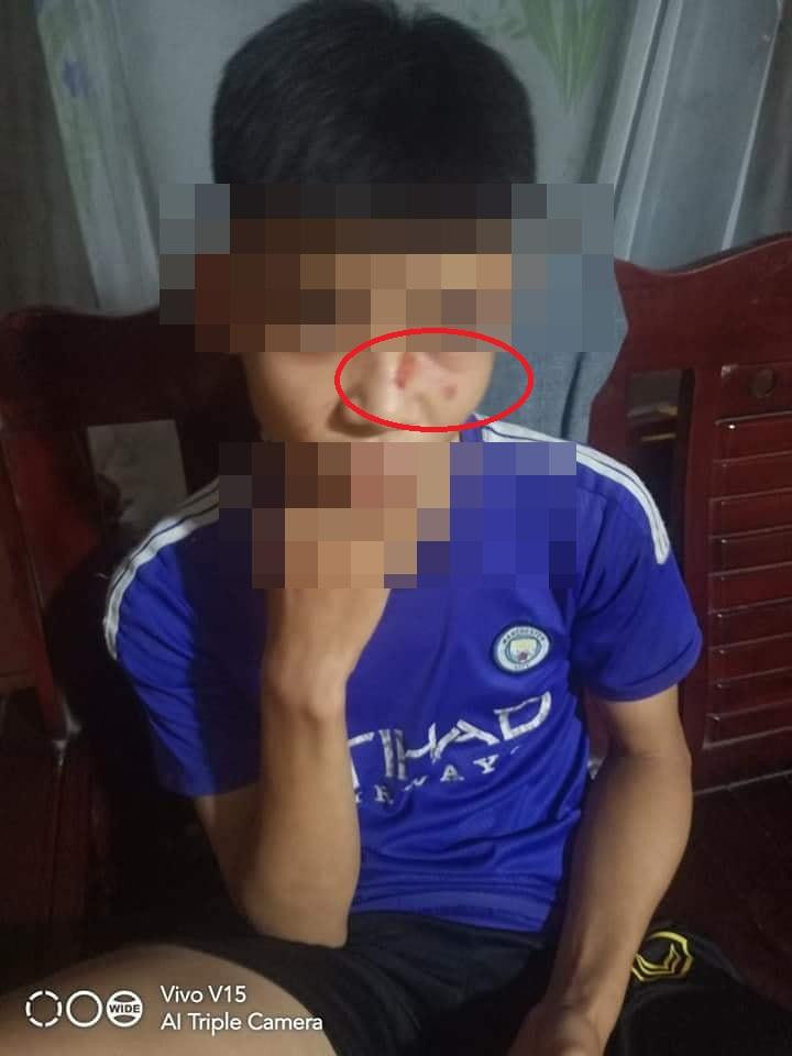 Vết xước do móng tay của thầy Bùi Văn T. để lại trên mặt học sinh Hà Văn M. Vết xước do móng tay của thầy Bùi Văn T. để lại trên mặt học sinh Hà Văn M.