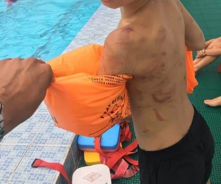 Những vết thương chi chít sau lưng của em Th. do bị ba đánh (Ảnh: CTV)