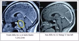 Kỹ thuật sử dụng dao gamma quay là kỹ thuật xạ phẫu tiên tiến trên thế giới, đưa Việt Nam trở thành một trong những nước đầu tiên trong trị u não Kỹ thuật sử dụng dao gamma quay là kỹ thuật xạ phẫu tiên tiến trên thế giới, đưa Việt Nam trở thành một trong những nước đầu tiên trong trị u não