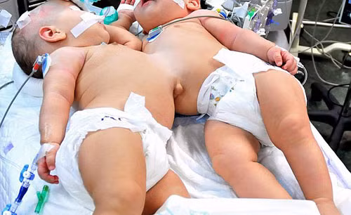 Hai bé gái từng chia sẻ với nhau phần bụng và phần gan - Ảnh: Reuters Hai bé gái từng chia sẻ với nhau phần bụng và phần gan - Ảnh: Reuters