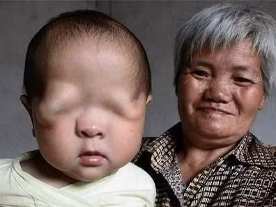 Bệnh không có mắt: hiệt thòi lớn lao đối với em bé sinh ra đã không có cơ hội nhìn thấy thế giới xung quanh. Với những trường hợp tương tự, các bác sỹ có thể dựa trên cấp độ nặng nhẹ và yếu tố hình thành từ ‘căn địa’ người mắc bệnh để tìm ra cách cứu chữa và cải thiện khả quan. Bệnh không có mắt: hiệt thòi lớn lao đối với em bé sinh ra đã không có cơ hội nhìn thấy thế giới xung quanh. Với những trường hợp tương tự, các bác sỹ có thể dựa trên cấp độ nặng nhẹ và yếu tố hình thành từ ‘căn địa’ người mắc bệnh để tìm ra cách cứu chữa và cải thiện khả quan.