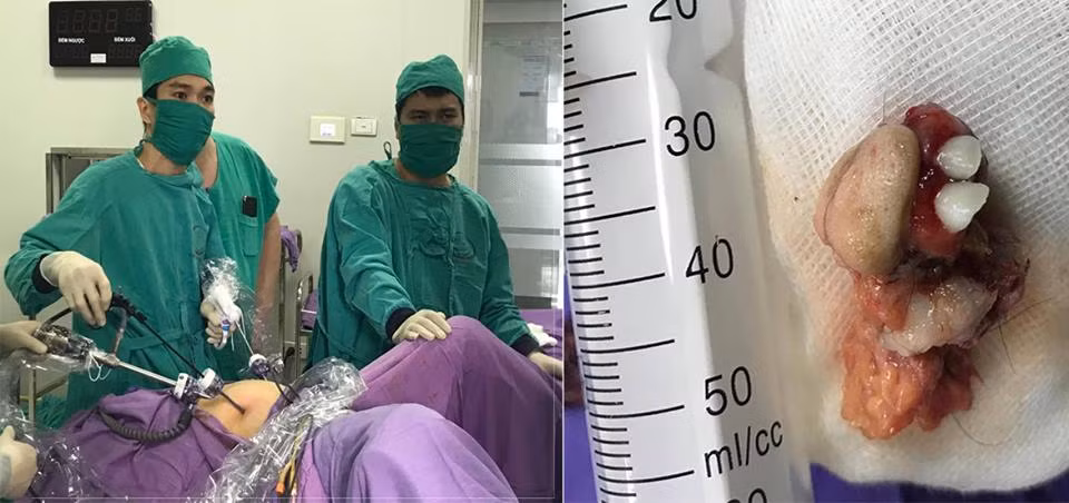 Ca mổ và khối u quái được đưa ra khỏi người bệnh nhân. (Ảnh: Bệnh viện sản nhi Quảng Ninh) Ca mổ và khối u quái được đưa ra khỏi người bệnh nhân. (Ảnh: Bệnh viện sản nhi Quảng Ninh)
