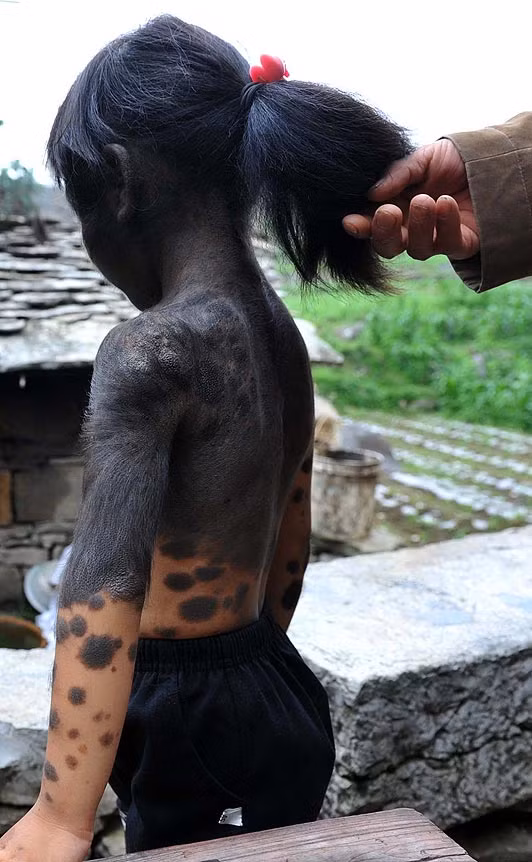 Bé Liu đã may mắn được một người họ hàng đón về nuôi nấng.