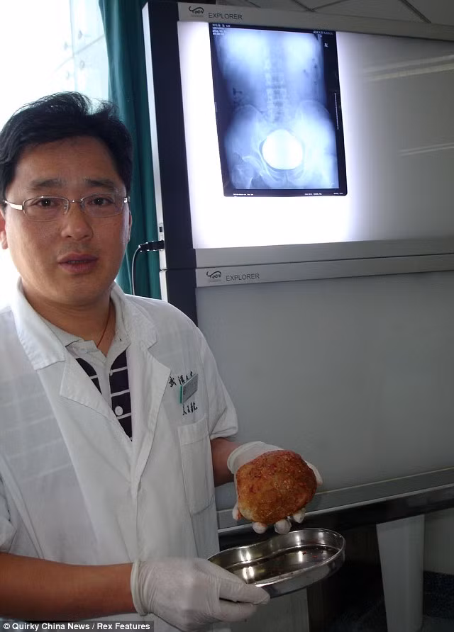 Tiến sĩ Wu và viên sỏi khổng lồ ông đã phẫu thuật lấy ra ngoài Tiến sĩ Wu và viên sỏi khổng lồ ông đã phẫu thuật lấy ra ngoài