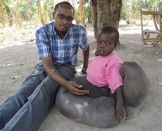 Cũng có người cho rằng cậu Một số bác sĩ Uganda cho rằng Vincent mắc chứng bệnh chân voi (elephantitis) và biến dạng mô.
