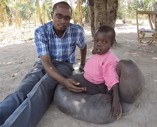 Cũng có người cho rằng cậu Một số bác sĩ Uganda cho rằng Vincent mắc chứng bệnh chân voi (elephantitis) và biến dạng mô.