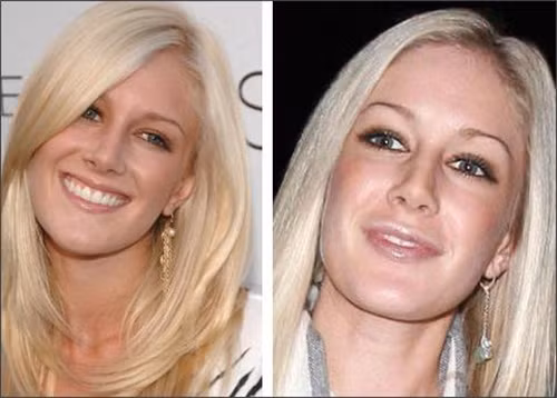 Không có lý do gì để cô nàng "ưa dao kéo" Heidi Montag không chăm chút đôi môi bằng botox. Không có lý do gì để cô nàng "ưa dao kéo" Heidi Montag không chăm chút đôi môi bằng botox.